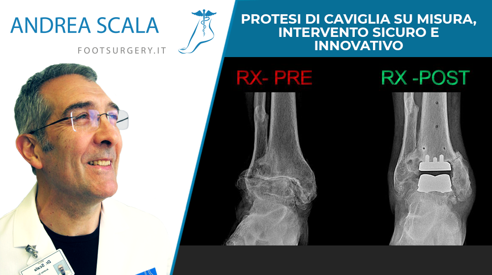 Protesi di caviglia su misura, intervento sicuro e innovativo