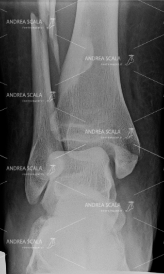 RXgrafia anteriore frattura tri-malleolare 2