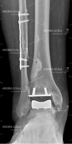 RXgrafia anteriore protesi della caviglia 8
