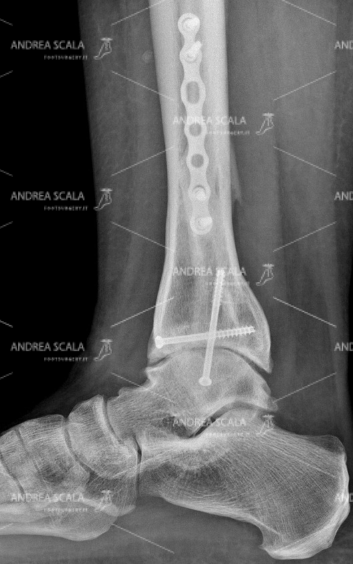 RXgrafia laterale della caviglia diminuzione spazio articolare 7