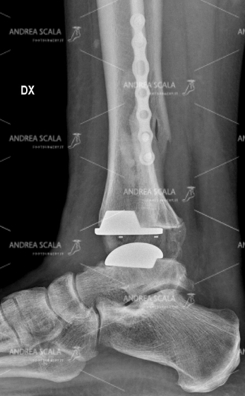 RXgrafia laterale protesi della caviglia