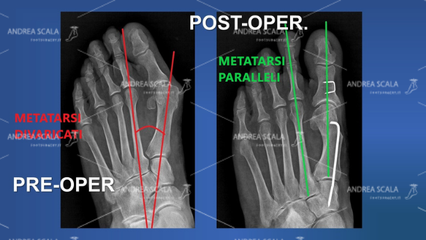 La RXgrafia mostra l’angolo della divaricazione del 1° metatarso. Anche il paziente può controllare da solo se il 1° metatarso è stato allineato ed è parallelo al 2° metatarso. Il sottile filo metallico che si vede è il sostegno dato al metatarso operato ed è l’assicurazione che il metatarso non sarà più divaricato dagli altri.