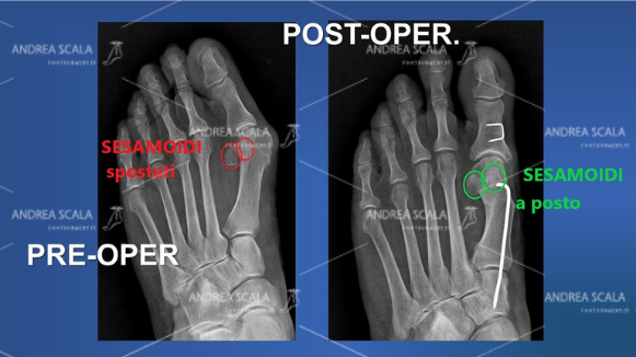 La RXgrafia mostra lo spostamento dei sesamoidi nello spazio tra i due metatarsi. Anche il paziente può controllare da solo se i sesamoidi sono stati correttamente posizionati sotto la testa del 1° metatarso.