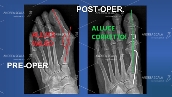 La RXgrafia mostra l’angolo di deviazione dell’alluce valgo prima dell’intervento. Anche il paziente può controllare da solo se l’alluce operato è stato messo bello diritto. Il sottile filo metallico che si vede è il sostegno dato all’alluce operato ed è l’assicurazione che l’alluce non tornerà mai più. 