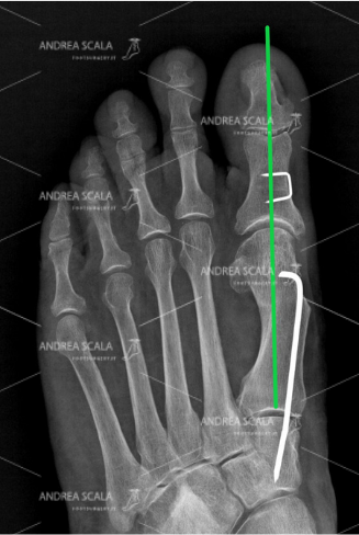 La RXgrafia POST-OPERATORIA mostra la correzione ottenuta con la tecnica personale del dott. Andra Scala. Questa correzione viene resa permanente dal filo metallico che stabilizza la osteotomia. L’alluce non può tornare! L’alluce operato non è più angolato. Il 1° metatarso è parallelo al 2°. I sesamoidi sono sotto la testa del 1° metatarsale.