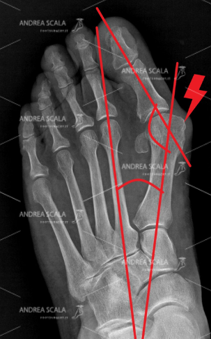 La RXgrafia PRE-OPERATORIA mostra la deformità dell’alluce valgo. La deviazione del 1° metatarso verso l'interno. La testa del 1° metatarso porta alla formazione di una protuberanza detta “ cipolla”. L'alluce privato dell’appoggio va a posizionarsi verso l’esterno, in valgo.