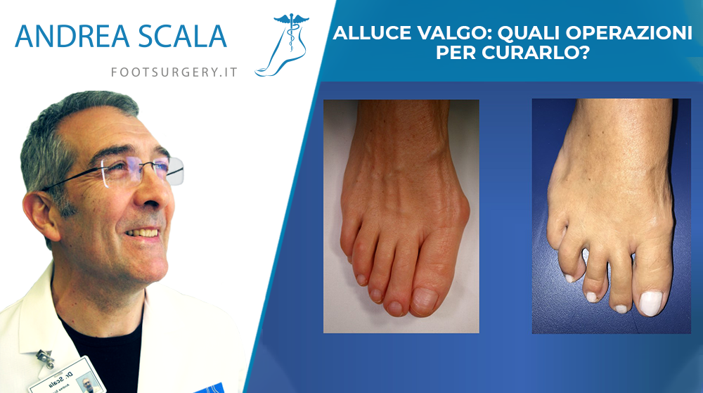 ALLUCE VALGO: QUALI OPERAZIONI PER CURARLO?