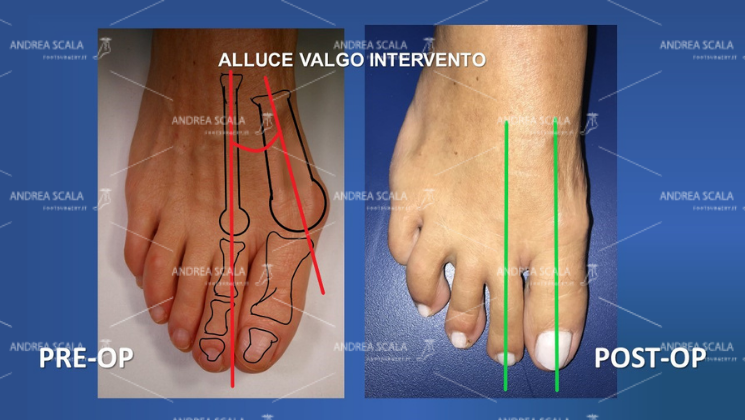 Nella immagine si vede l’alluce valgo prima dell’intervento e il risultato dell’intervento. In particolare si vede l’ angolo intermetatarsale patologico e la successiva correzione dell’ angolo intermetatarsale dell’alluce valgo.