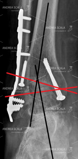 artrosi-caviglia- asse -spostato-1.jpeg