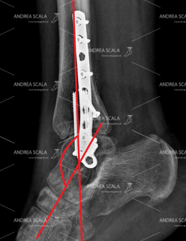 La RXgrafia laterale mostra una grave artrosi della caviglia dopo un grave trauma. Oltre alla artrosi la caviglia è completamente deviata in equino.