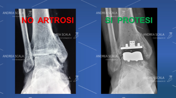 Le RXgrafie laterali della caviglia mettono a confronto la artrosi della caviglia con la protesi. Prima dell’intervento si vede l’artrosi e la compromissione dello spazio articolare. La protesi della caviglia ripristina lo spazio articolare e restituisce il movimento