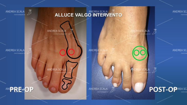 Nella immagine si vede l’alluce valgo prima dell’intervento e il risultato dell’intervento. In particolare si vede la posizione dei sesamoidi patologica e la successiva correzione della posizione dei sesamoidi.