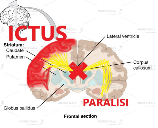 Il disegno mostra in modo elementare che dopo l’ictus le cellule cerebrali muoiono. Non avviene il passaggio degli impulsi elettrici dall’altra parte del cervello. Tutti comprendono che la parte del corpo opposta all’ictus rimane paralizzata. Non c’è rigenerazione. Non c’è ripresa della elettricità. Non c’è “neuroplasticità”. Solo chi ha uno scopo diverso dal benessere insiste per anni con terapie inutili.