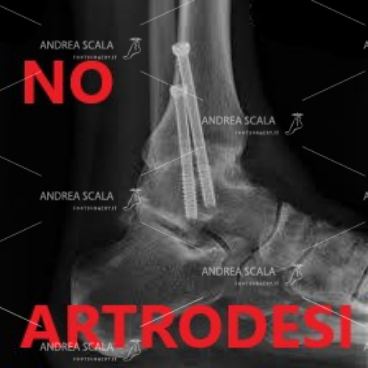 L’artrodesi della caviglia non è un innocente intervento privo di conseguenze. Può divenire una situazione invalidante con il tempo.