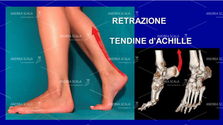 Lo schema mostra che la paralisi muscolare dovuta all’ictus provoca la retrazione del tendine d’Achille. A causa della paralisi il calcagno non appoggia al suolo. Nessun botulino e nessuna riabilitazione possono allungare il tendine d’Achille e fare toccare il calcagno al suolo. Solo l’intervento chirurgico può fare questa correzione. Solo chi ha uno scopo diverso insiste per anni con terapie inutili. Solo chi ha uno scopo diverso dalla correzione non comprende che la malattia del cervello non c’entra nulla con la paralisi del piede. Sono due cose distinte e separate. 