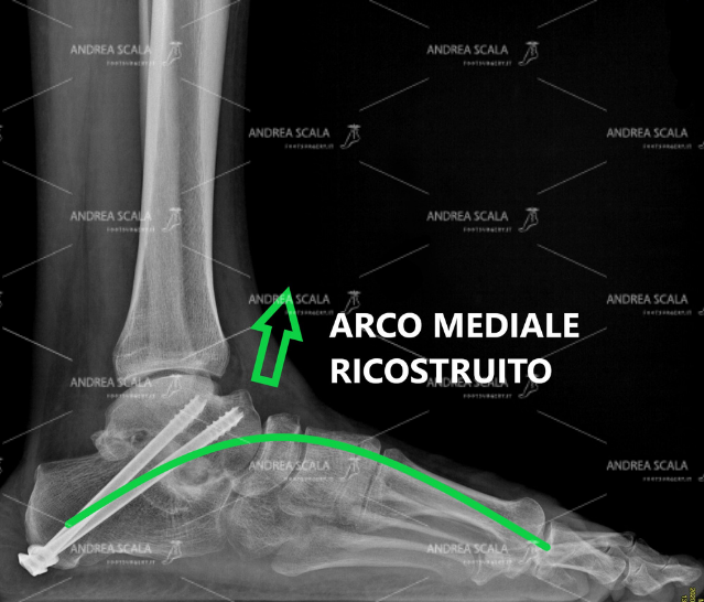 La RXgrafia post-operatoria mostra l’effetto della artrodesi con viti e innesto osseo astragalo-calcaneale. L’arco mediale del piede è ricostruito e sollevato dal suolo.