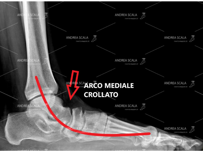 La RXgrafia mostra il grave cedimento dell’arco del piede nel piede piatto valgo pronato dell’adulto.