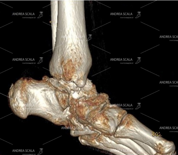 La TAC mostra un piede piatto valgo con grave artrosi presente tra astragalo e calcagno. L’artrodesi non tocca la caviglia che è indenne dalla artrosi.