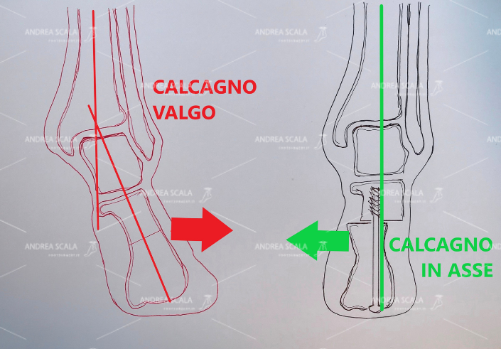 La osteotomia del calcagno consiste in un intervento poco invasivo e che permette al soggetto di recuperare i movimenti in tempi brevi. L'unica condizione per affrontare un intervento di questo tipo, però, è che la cartilagine della articolazione tra astragalo e calcagno non sia già ad uno stato di degenerazione irrimediabile.