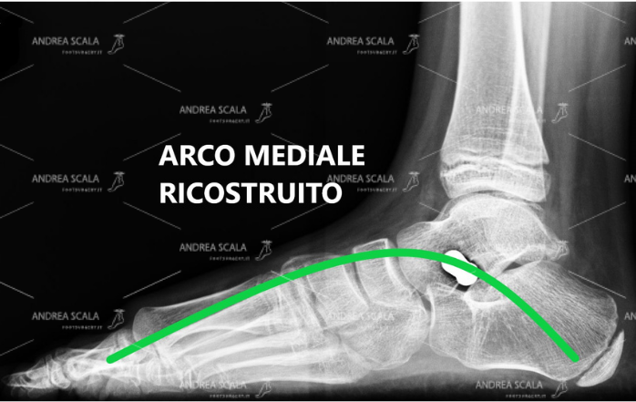 La RXgrafia post-operatoria mostra l’effetto della endortesi astragalo-calcaneale. L’arco mediale del piede è ricostruito e sollevato dal suolo.