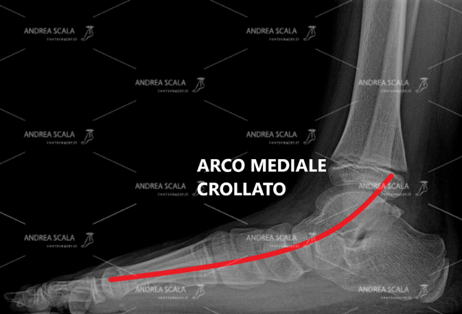 La RXgrafia mostra il grave cedimento dell’arco del piede nel piede piatto valgo pronato dell’infanzia