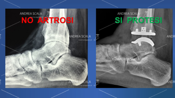  Le RXgrafie anteriori della caviglia mettono a confronto la artrosi della caviglia con la protesi della caviglia: L’artrosi comporta compromissione dello spazio articolare. La protesi ripristina lo spazio articolare e restituisce il movimento