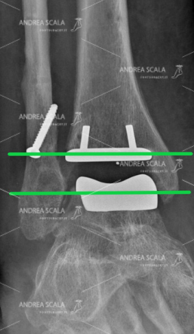 La RXgrafia anteriore mostra la protesi della caviglia, le componenti sono ben allineate e si vede lo spazio articolare occupato dal polietilene mobile. Si è accuratamente evitato l’accesso laterale per non creare instabilità in una caviglia già molto sofferente.