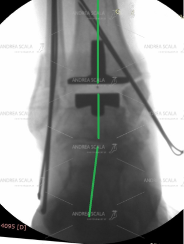 La radiografia intra operatoria mostra il perfetto allineamento della protesi di caviglia al termine dell’intervento.