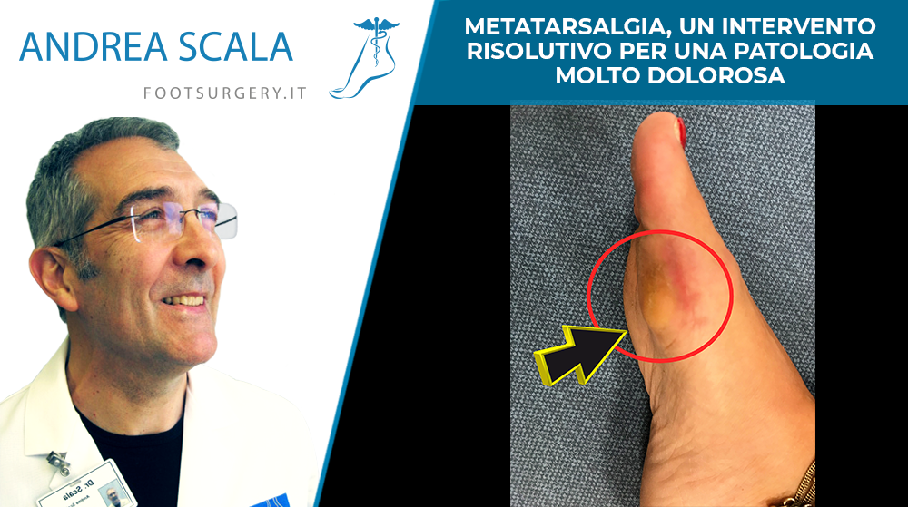 Metatarsalgia, un intervento risolutivo per una patologia molto dolorosa