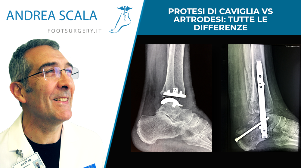 Protesi di caviglia vs artrodesi: tutte le differenze