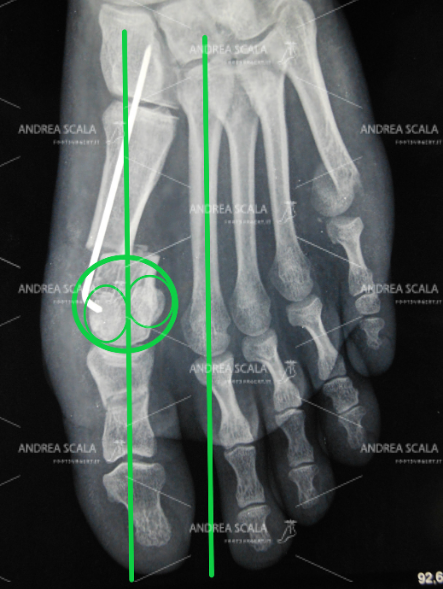 La RXgrafia post-operatoria spiega bene i motivi del corretto risultato ottenuto con la tecnica mini-invasiva del dott. Andrea Scala. Tutte le deformità sono state corrette. La testa del 1° metatarso (“cipolla”) è stata tagliata e spostata. L’alluce è stato allineato. I due metatarsi sono paralleli e non più divaricati I sesamoidi sono stati riposizionati sotto la testa del 1° metatarsale. Con questa metodica c’è l’assicurazione che l’alluce valgo non può tornare.