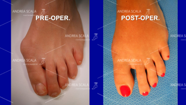 L’illustrazione mette a confronto come si presenta l’alluce valgo prima dell’intervento e il risultato ottenuto dopo l’intervento con la tecnica del dottor Andrea Scala.