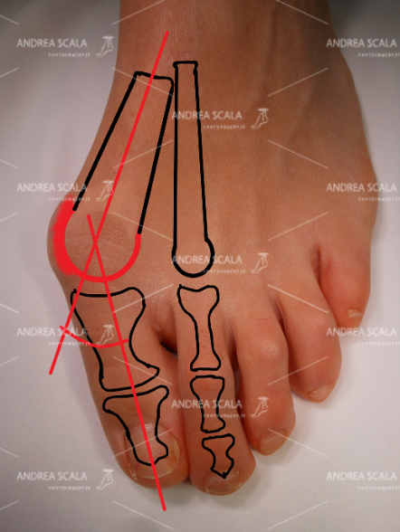 La “cipolla” è causata dalla sporgenza della testa del 1° metatarsale sotto la pelle. La gravità dell’alluce viene misurata dall’angolo dell’alluce valgo con il 1° metatarso. Si vede molto bene nelle RXgrafie,
