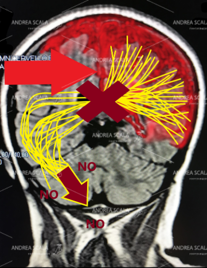 Lo schema mostra in modo elementare che l’ictus porta alla morte le cellule cerebrali. Dopo l’emorragia (oppure l’ischemia) non avviene il passaggio degli impulsi elettrici dall’altra parte del cervello. A causa dell’ictus la parte opposta del corpo rimane paralizzata. Si verifica l’emiplegia.