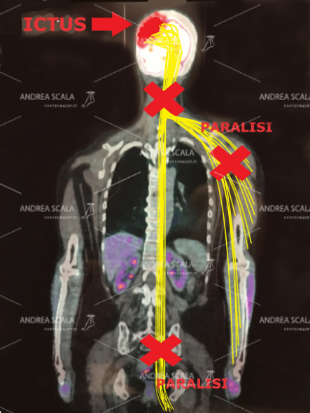 Lo schema mostra l’emiplegia. La metà del corpo opposta all’ictus subisce la interruzione della elettricità che proviene dal cervello. A questo è dovuta la paralisi dell’arto superiore e dell’arto inferiore. Questa elettricità non tornerà mai. E’ inutile aspettare una “rigenerazione” che non è scientificamente possibile.