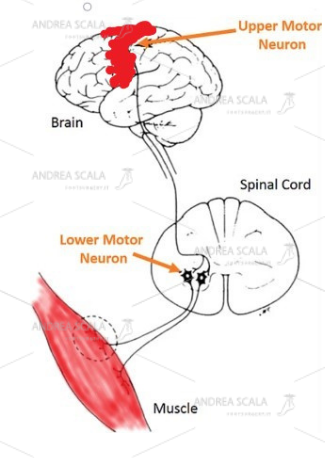 Lo schema della paralisi muscolare dovuta all’ictus. Le cellule cerebrali sono morte dopo l’ictus e l’elettricità che passa dall’altra parte del corpo non c’è più. I neuroni che sono nel midollo spinale rimangono privi di ordini superiori. I muscoli degli arti ricevono ordini disordinati e non regolati dal midollo spinale. Per questo motivo alcuni muscoli sono immobili e paralitici e altri sono ipertonici e spastici.