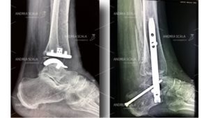 rx-protesi-di-caviglia-dott-andrea-scala-1-jpeg