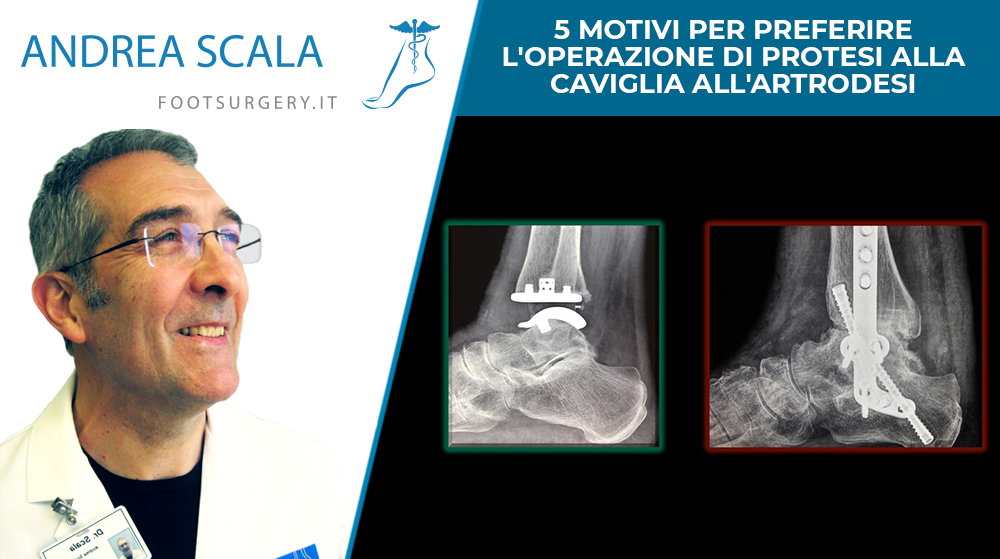 5 motivi per preferire l’operazione di protesi alla caviglia all’artrodesi