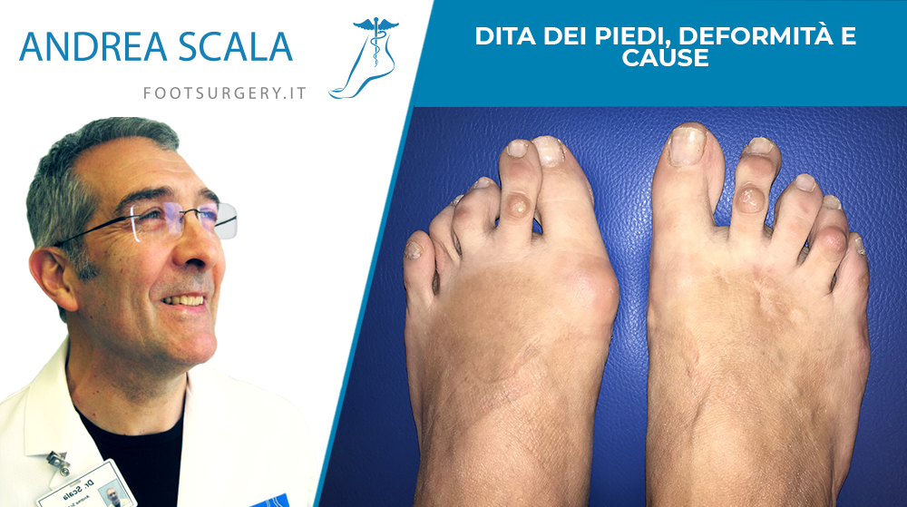 Dita dei piedi, deformità e cause