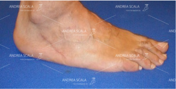 L’incisione chirurgica sulla base del 5° metatarso mostra la sede del prelievo della inserzione del t. Peroneo Breve.