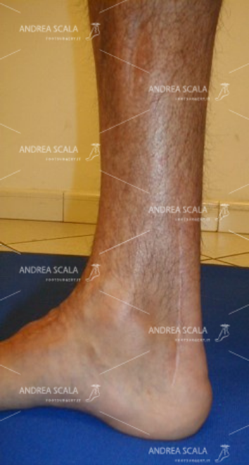 L’incisione chirurgica sul t. d’Achille mostra la sede dell’allungamento.