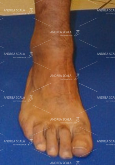 Incisione chirurgica sul 1° cuneiforme, ove è stato trasferito il t. Peroneo Breve. Il piede non è equino, ha un corretto appoggio plantare e non è più ciondolante.