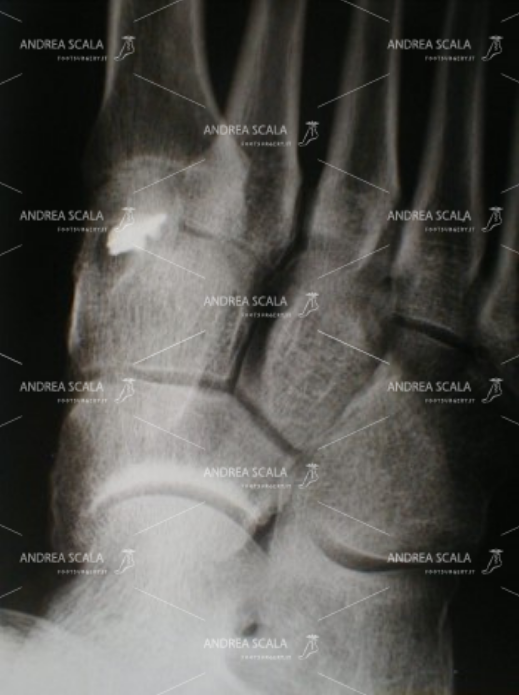 La radiografia mostra l’ancora metallica sul 1° cuneiforme, nella sede in cui è stato il t. del Peroneo Breve.