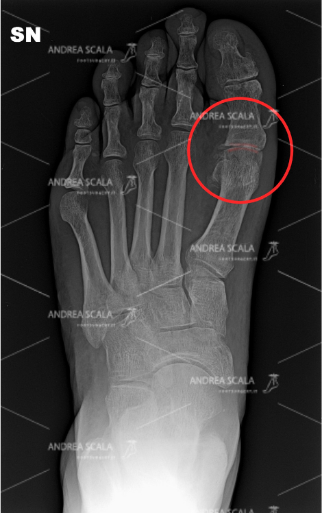 La radiografia mostra l’artrosi a carico dell'articolazione metatarso-falangea, che si trova alla base dell’alluce e sulla testa del primo metatarso