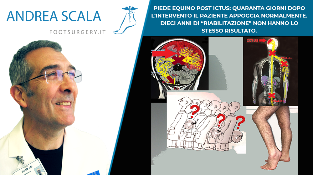 PIEDE EQUINO POST ICTUS: QUARANTA GIORNI DOPO L’INTERVENTO IL PAZIENTE APPOGGIA NORMALMENTE.  DIECI ANNI DI “RIABILITAZIONE” NON HANNO LO STESSO RISULTATO.