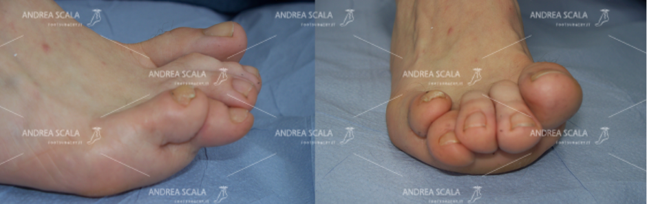 Lo squilibrio muscolo-tendineo tra estensori e flessori delle dita è la causa più frequente delle deformità delle dita del piede.