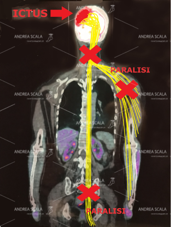  Lo schema mostra in modo elementare l’ictus  che porta alla morte le cellule cerebrali. Dopo l’emorragia (oppure l’ischemia) non avviene il passaggio degli impulsi elettrici dall’altra parte del cervello. A causa dell’ictus la parte opposta del corpo rimane paralizzata. Si verifica l’emiplegia. La “rigenerazione” non è scientificamente possibile.