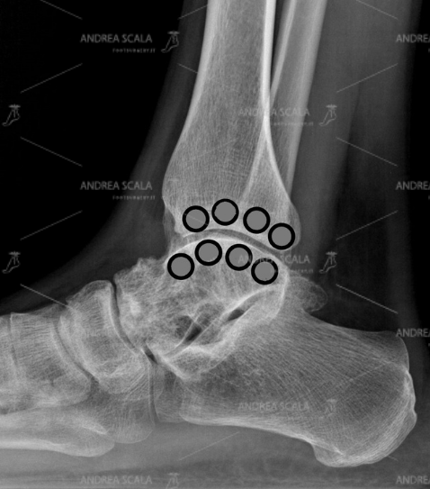 RX  EMANUELE La RXgrafia dimostra che l’astragalo è appiattito. I fori per ottenere la superficie curva dell’astragalo sono pericolosi in quanto asportano troppo osso  e possono sconfinare nell’articolazione sottostante (sottoastragalica) che non c’entra niente.