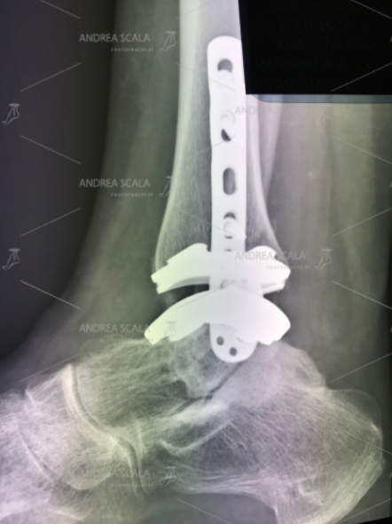 La RXgrafia di una protesi Zimmer fa vedere che l’astragalo ha mangiato troppo osso dell’astragalo e la protesi intacca articolazione sottostante (sottoastragalica) che non c’entra. E’ la dimostrazione che il taglio curvo non serve, ma può essere pure dannoso.