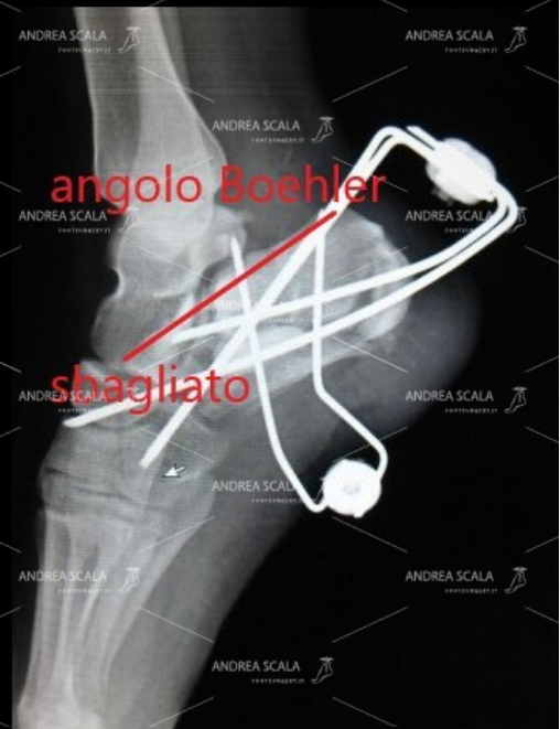 La Radiografia mostra la frattura di calcagno curata con i fili di acciaio. Si vede molto bene che il calcagno è rimasto schiacciato. L’angolo di Bohler non è stato ripristinato, questo fa capire che l’articolazione non è stata ricostruita,